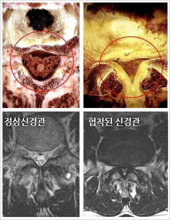 협착증증세