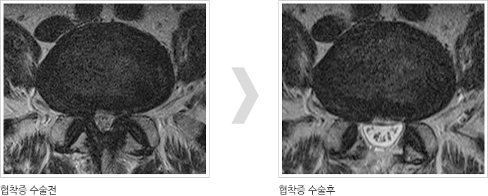협착증수술전후사진