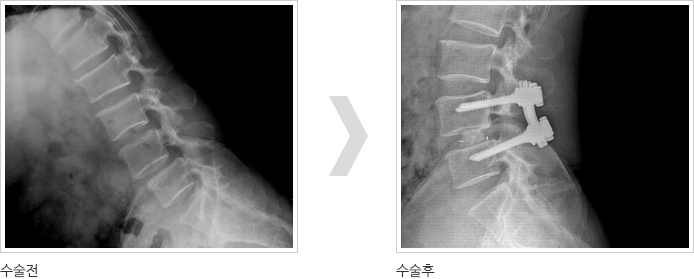 수술전후사진